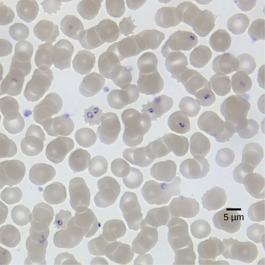 The micrograph shows round red blood cells, each about 8 microns across, infected with ring-shaped P falciparum.