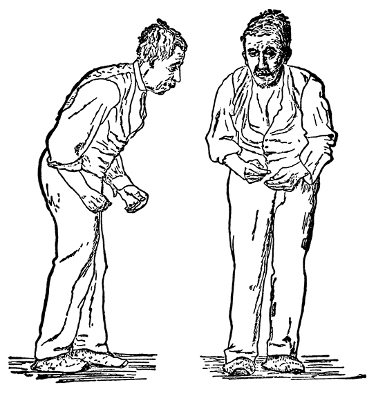 Illustration shows a hunched man with stiff arms and a shuffling walk.