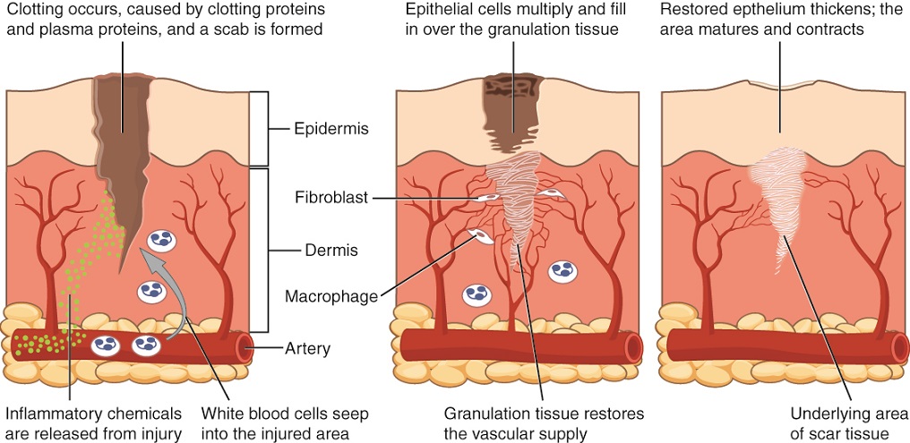 This diagram shows the wound healing process in three steps. Each step shows a cross section of wounded skin. The wound extends through the upper layer of skin, labeled the epidermis, about halfway through the dermis, the lower deeper layer of skin. At the base of the cross section, an artery runs horizontally through fatty tissue below the dermis. Several small capillaries branch from the artery and travel into the upper regions of the dermis. In the first step of healing, inflammatory chemicals, symbolized with green dots, are released from the injury site. The chemicals travel through the dermis and enter the horizontal artery. Clotting proteins and plasma proteins also initiate clotting within the wound, forming a scab, which is clearly visible in the second step as a black and brown mass covering the upper regions of the wound. Below the scab, epithelial cells in the epidermis multiply and begin to fill in the wound. In the dermis, three fibrocytes are binding the wound area with white tissue. This tissue is granulation tissue. Laying down granulation tissue restores the vascular supply, as indicated by capillaries growing around the wounded area. In the third step, the scab is gone and the epidermis has grown in and contracted to seal the upper portion of the wound. In the deeper regions, the wound is now completely filled with granulation tissue with is now considered scar tissue.