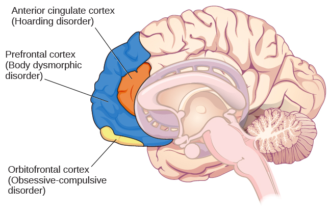 An illustration of the brain identifies the location of three areas and their associated disorders: the anterior cingulate cortex (hoarding disorder), the prefrontal cortex (body dysmorphic disorder), and the orbitofrontal cortex (obsessive-compulsive disorder).