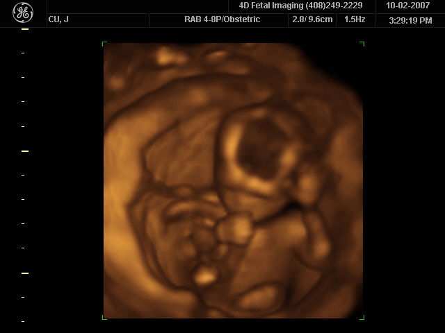 This is an image of a 3D ultrasound scan of the fetus showing an unborn baby sucking its thumb.