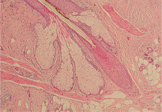 This micrograph is of the base of a hair follicle. The protruding hair is largely transparent, with only its dark outline visible. The inner root sheath is visible surrounding the very bottom of the hair as a circle of cells with dark-staining nuclei. The inner sheath extends up the hair shaft. The outer root sheath is much thicker than the inner root sheath, consisting of a large oval of lighter staining cells. The oval surrounds the bottom of the hair and extends into the hypodermis.