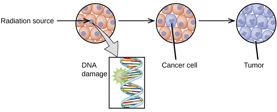 A diagram is shown which has a white sphere followed by a right-facing arrow and a large sphere composed of many smaller white and green spheres. The single sphere has impacted the larger sphere. A right-facing arrow leads from the larger sphere to a pair of smaller spheres which are collections of the same white and green spheres. A starburst pattern lies between these two spheres and has three right-facing arrows leading from it to two white spheres and a circle full of ten smaller, peach-colored circles with purple dots in their centers. An arrow leads downward from this circle to a box that contains a helical shape with a starburst near its top left side and is labeled “D N A damage.” A right-facing arrow leads from this circle to a second circle, with nine smaller, peach-colored circles with purple dots in their centers and one fully purple small circle labeled “Cancer cell.” A right-facing arrow leads to a final circle, this time full of the purple cells, that is labeled “Tumor.”
