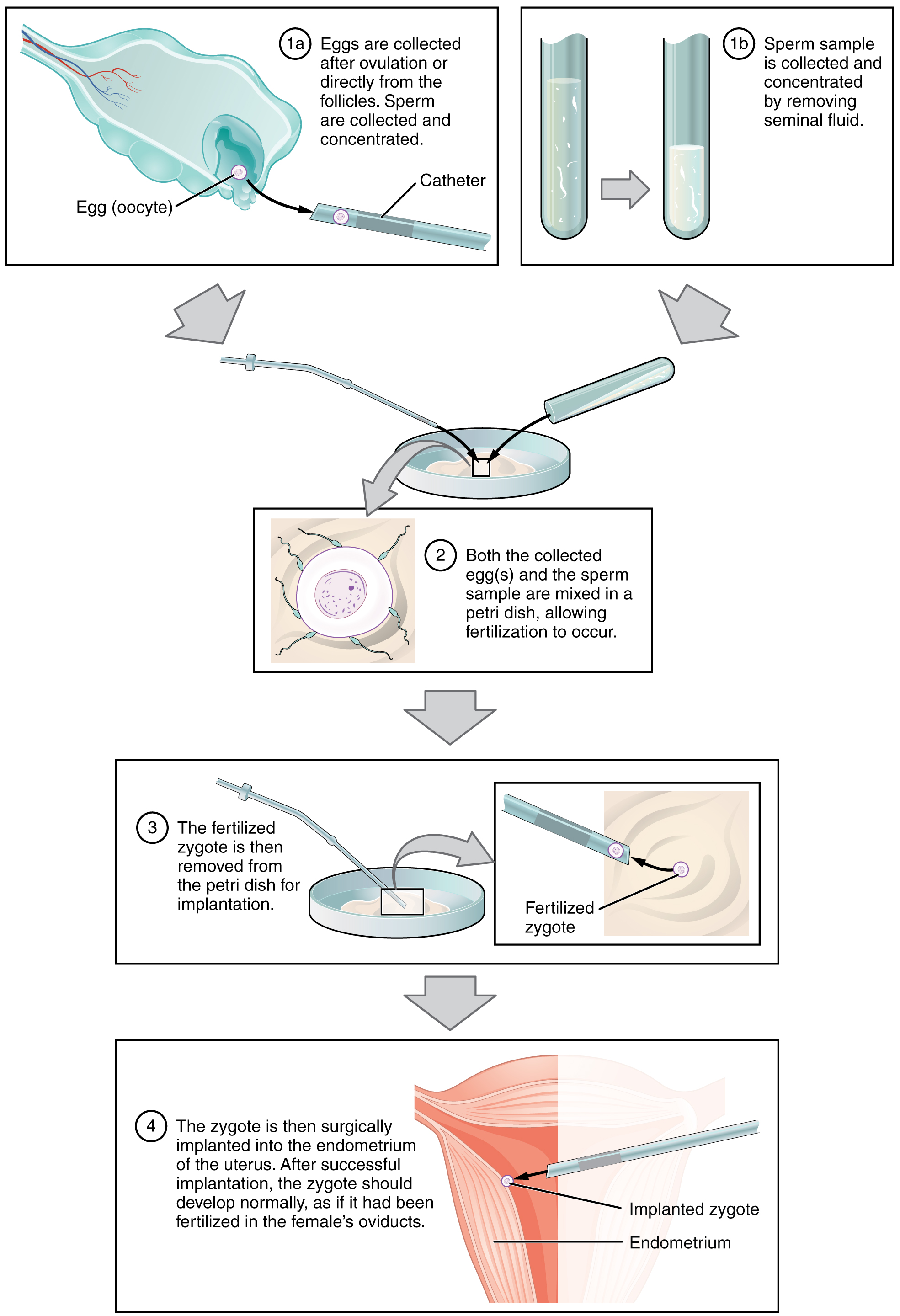 This multi-part figure shows the different steps in in vitro fertilization. The top panel shows how the oocytes and the sperm are collected and prepared. The next panel shows the sperm and oocytes being mixed in a petri dish. The panel below that shows the fertilized zygote being prepared for implantation. The last panel shows the fertilized zygote being implanted into the uterus.