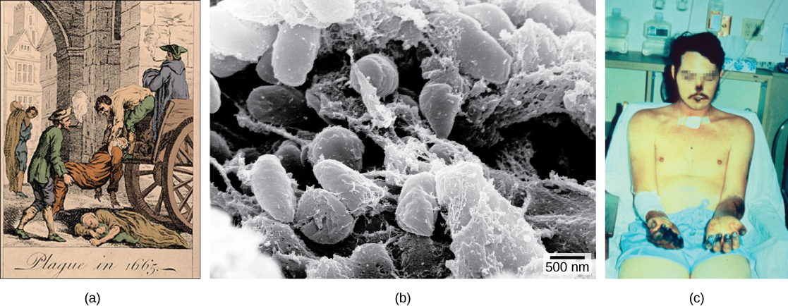 Illustration A shows two men loading a dead body onto a cart. Another body lies in the street. Label beneath the illustration says, “Plague in 1665.” Micrograph B shows rod-shaped bacteria. Photo C shows a man with black gangrene on his fingers, arm, nose and lips.