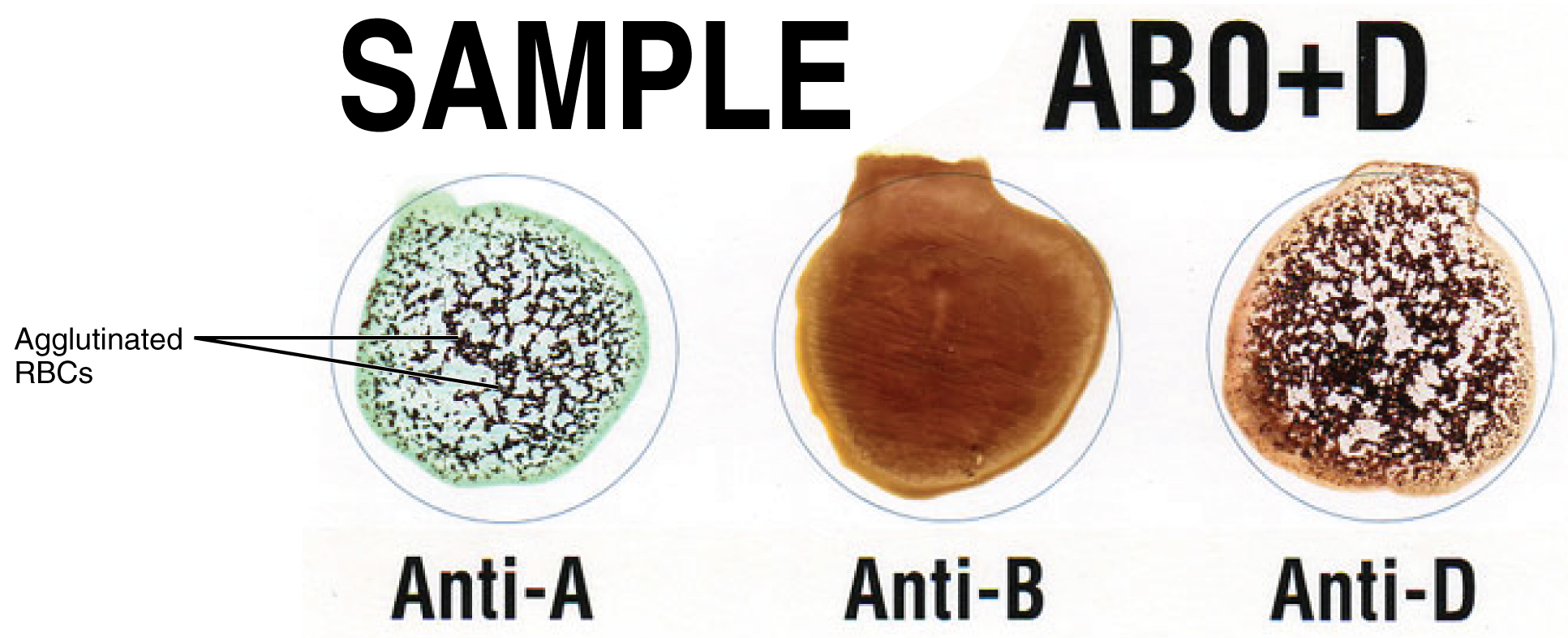 This figure shows three different red blood cells with different blood types.