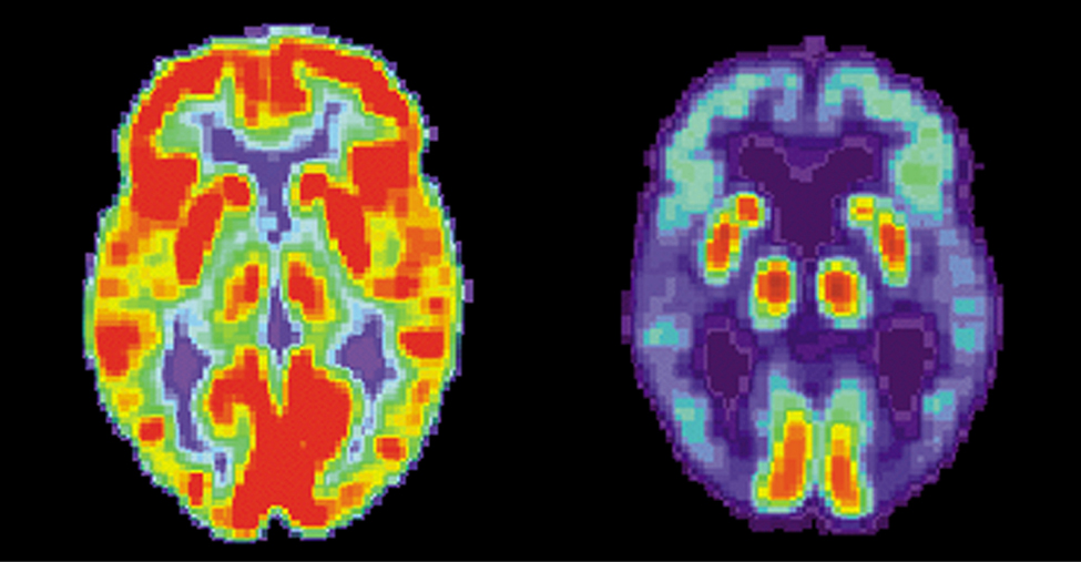 Two images of brains are shown. The one on the left has many red and orange areas and some blue areas. The one on the right is mostly blue with very small areas in red and yellow.