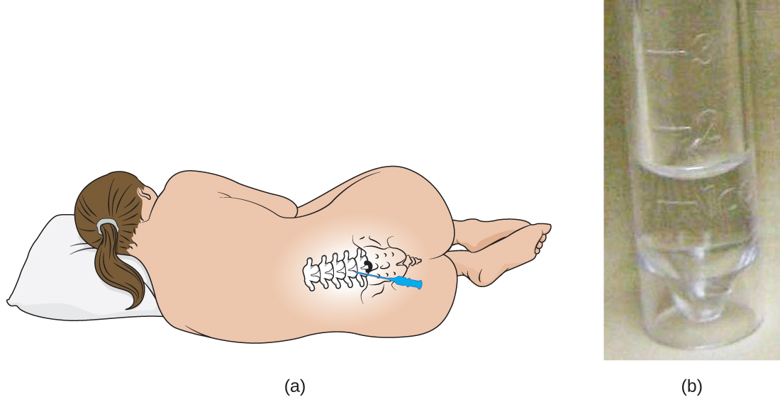 Figure a is a drawing of a person lying on their side with their back showing. An overlay drawing shows the location of the spine with an arrow pointing to between two vertebrae in the lower back. Figure b is a photograph of a covered test tube containing a clear liquid