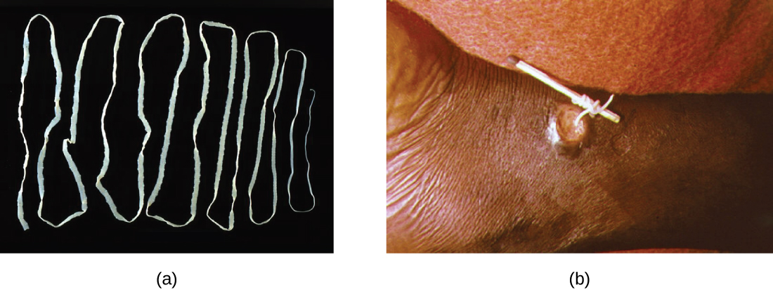 Figure a is a photograph of a long, flat, white worm folded back and forth on a black background. Figure b shows a lesion on a patient. A worm is being pulled out of the lesion and being wrapped around a matchstick