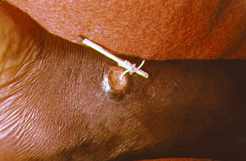 A worm is being pulled out of  a wound in the leg of an infected individual.