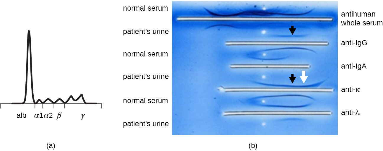 a) A graph showing a large peak at alb and smaller peaks at alpha1, alpha2, beta, and gamma.  B) A photograph showing various white lines on a blue background. The top line is labeled anti-human whole serum, the next is anti-IgG, the next is anti-IgA, the next is anti-K and the next is anti-lambda. Each of these is near a band from both the normal and patient urine samples. Black arrows point to the patient’s sample next to anti-IgG and anti-k. A white arrow points to the band from the patient near anti-K.