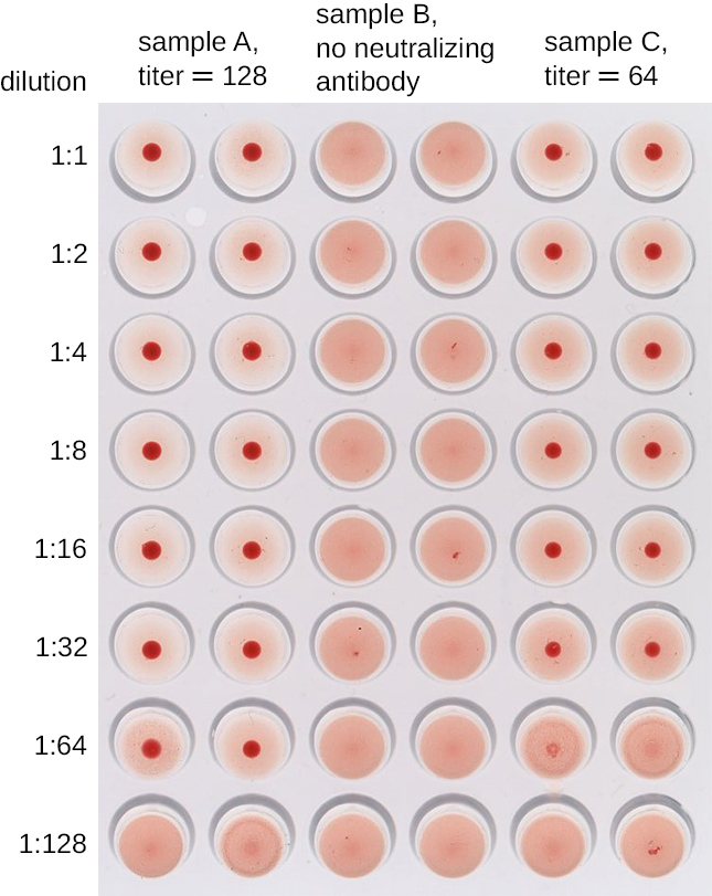 A drawing of a well plate. The label at the top reads: Dilution. The rows are labeled: 1:1, 1:2, 1:4, 1:8, 1:16, 1:32, 1:64, 1:128. The columns are labeled: Sample A, titer = 128 (this spans columns 1 and 2). Sample B, no neutralizing antibody (spans columns 3 and 4). Sample C, titer = 64 spans columns 5 and 6.). Columns 1 and 2 have red dots in all rows but the bottom one. Columns 3 and 4 have no red dots. Columns 5 and 6 have red dots in all rows but the bottom two.