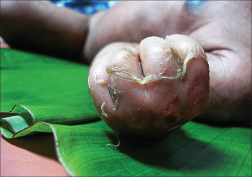 Skin peeling off a hand.