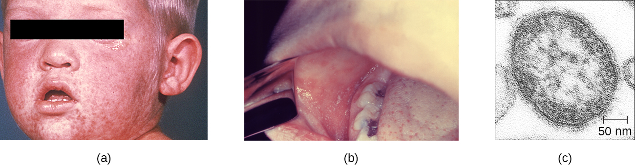 a) Red bumps on a child’s face. B) Red spots inside the mouth. c) A micrograph of an oval structure containing a scale bar measuring 50 nanometers.