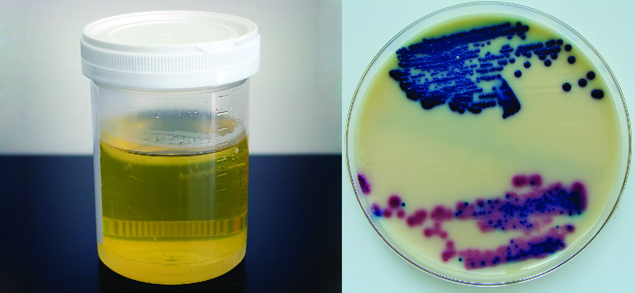 a small container filled with urine is shown on the left. The picture on the right shows a disc with a peach colored film that is spotted with red and blue spots.