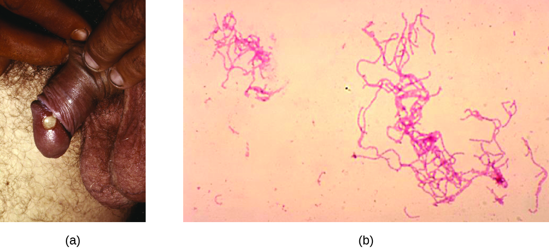 a) Photo of a white swelling on a penis. B) micrograph of rod shaped pink cells.