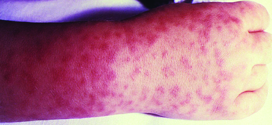 Photo of many red spots on a person’s hand.